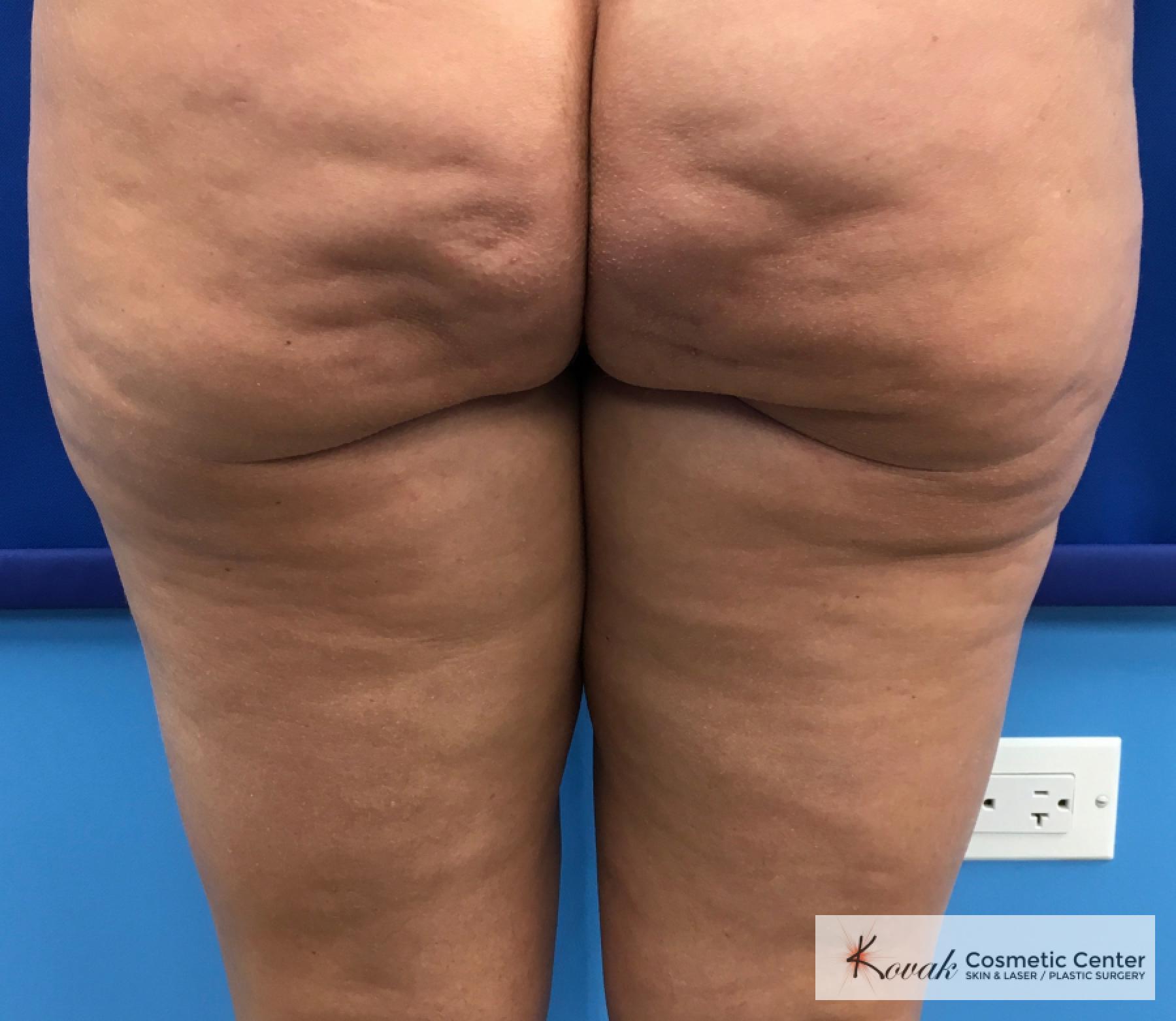 Cellulite Reduction: Patient 4 - Before 