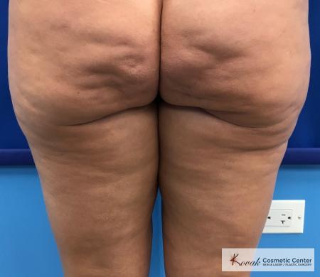 Cellulite Reduction: Patient 4 - Before 1