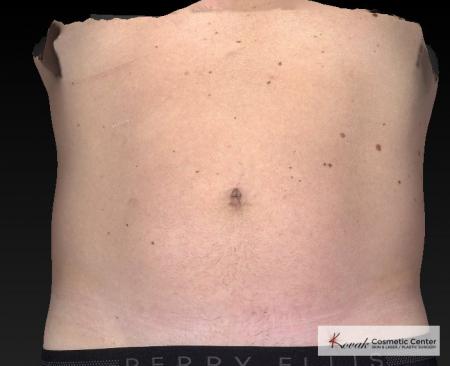 CoolSculpting®: Patient 19 - Before 1