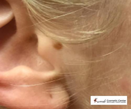 Mole Removal: Patient 3 - Before 