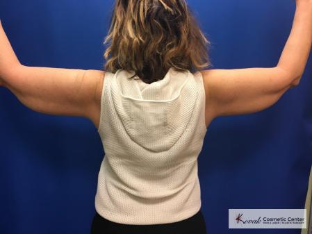 Laser Liposuction: Patient 6 - Before and After 2