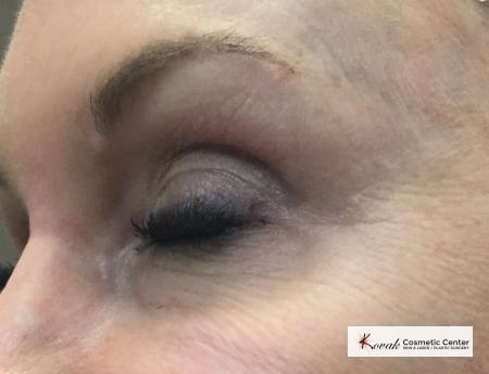 ThermiSmooth®: Patient 1 - Before 