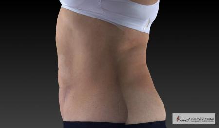 CoolSculpting®: Patient 18 - Before and After 5