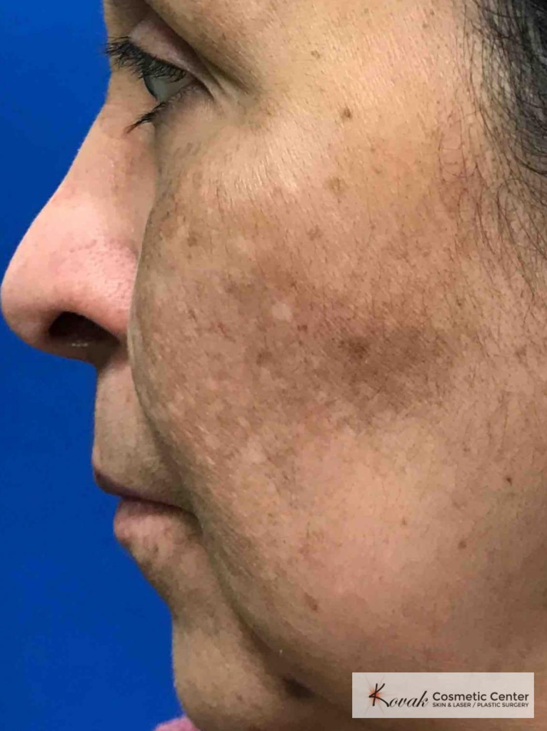 Melasma treatment using Venus Viva on a 57 year old female - After  