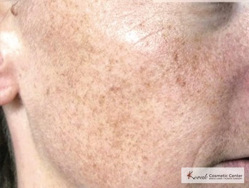Tyte And Bryte Photorejuvenation: Patient 1 - Before 