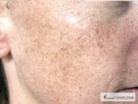 Tyte And Bryte Photorejuvenation: Patient 1 - Before 1