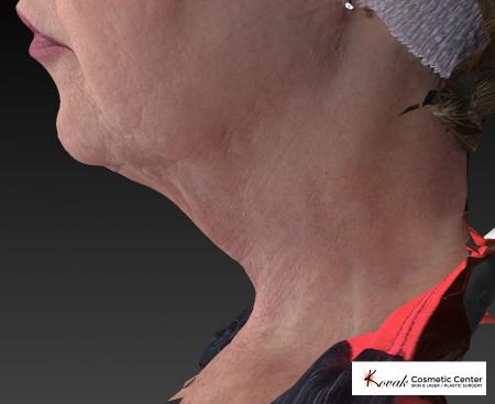 Kybella: Patient 2 - Before and After Image 4