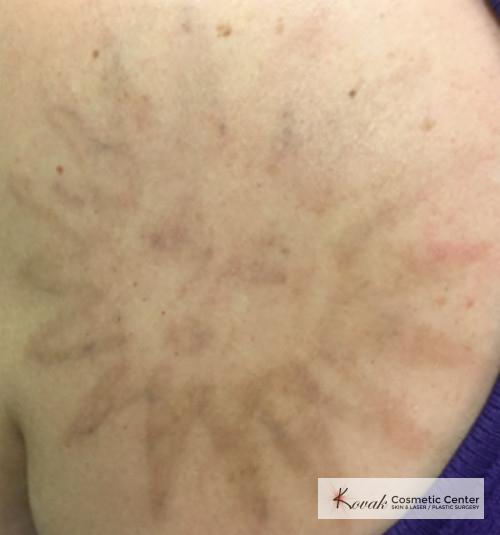 Tattoo Removal: Patient 3 - After  