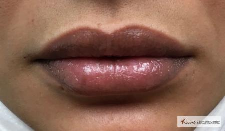 Restylane Kysse Treatment on a 37 year old female to fill the lips - After 1