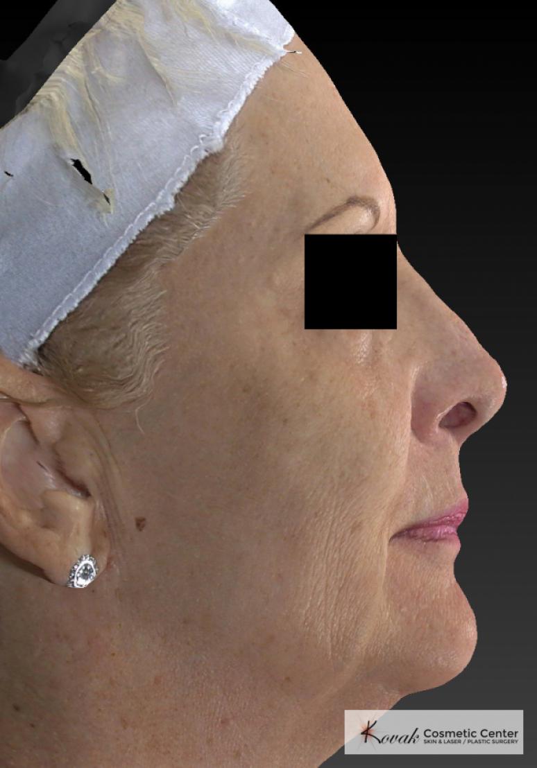 Sculptra®: Patient 4 - After  