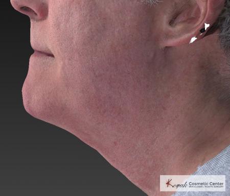 Kybella: Patient 4 - After Image 2