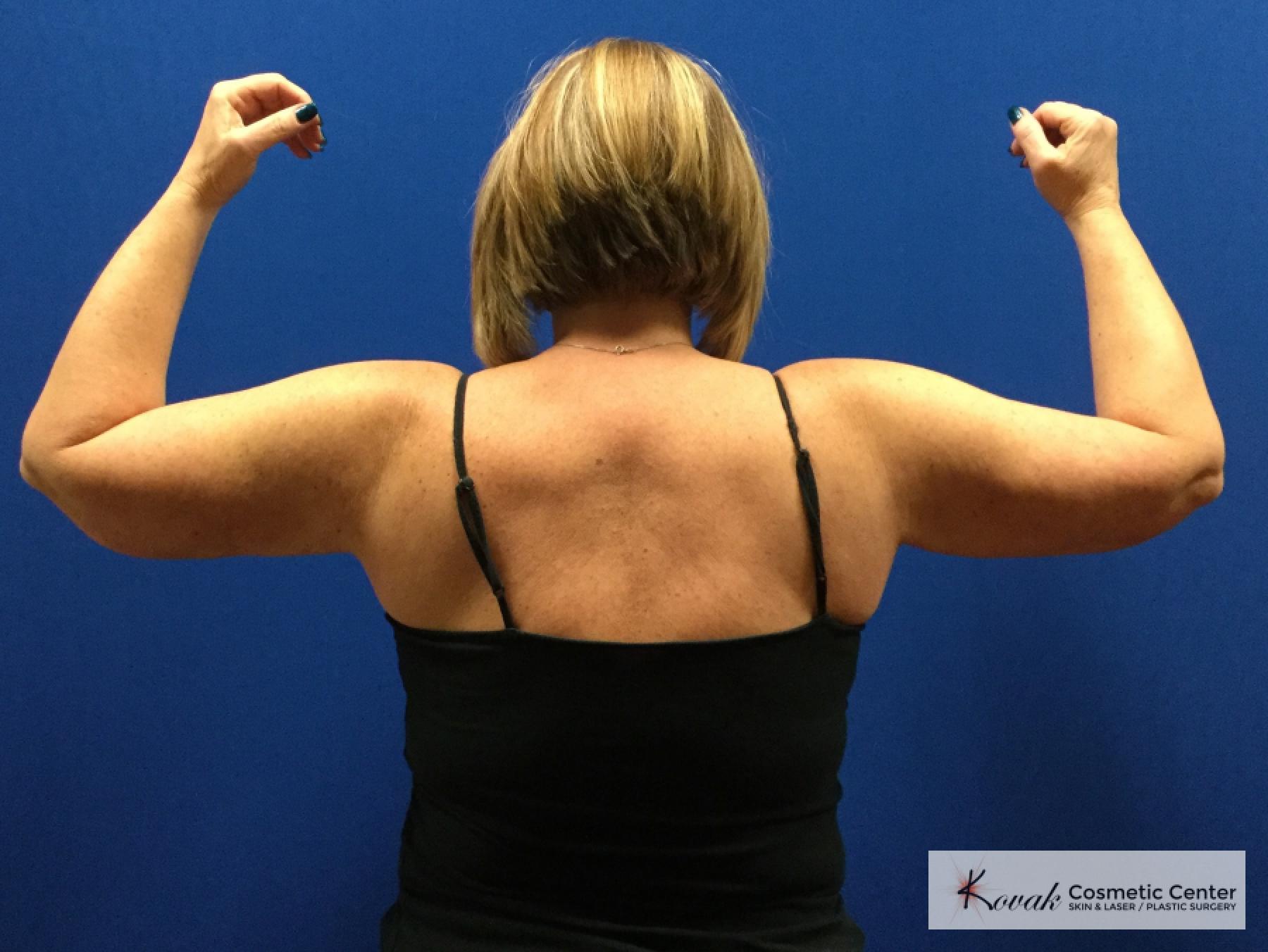 Laser Liposuction of the arms on a 42 year old woman - Before 