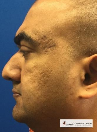 Venus Viva: Patient 2 - Before and After Image 3