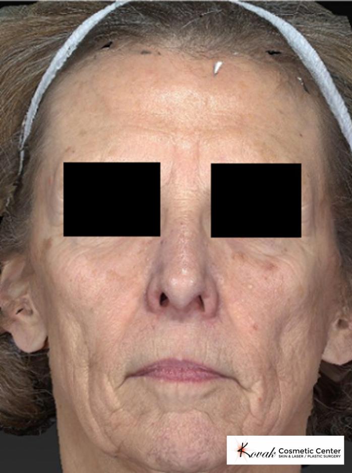 Sculptra®: Patient 2 - Before 