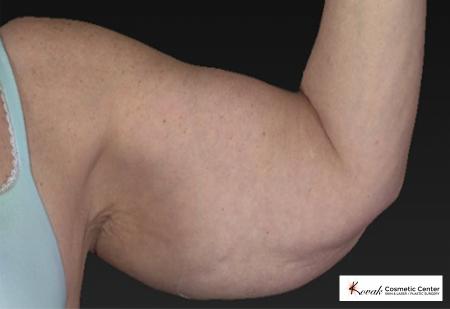 CoolSculpting®: Patient 14 - Before and After 2