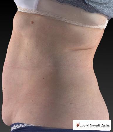 CoolSculpting®: Patient 12 - After 4