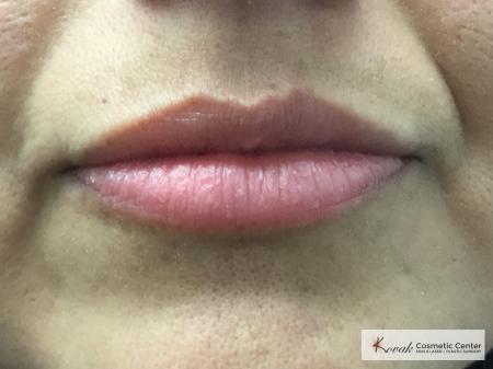 Juvederm treatment to fill the lips on 37 year old female - After  