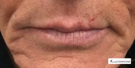 Injectables - Mouth: Patient 1 - Before Image 1