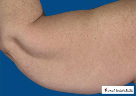 CoolSculpting®: Patient 14 - Before