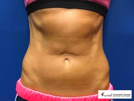 CoolSculpting of the flanks and abdomen on a 50 year old female - After