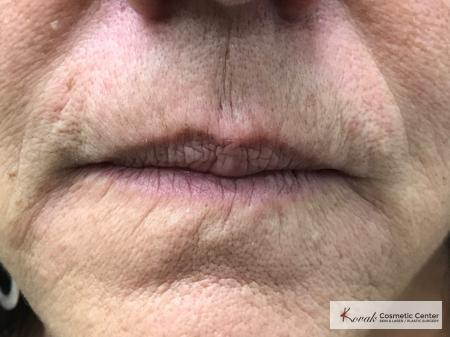 Restylane Silk for fine lines around the mouth on a 69 year old female - Before 1