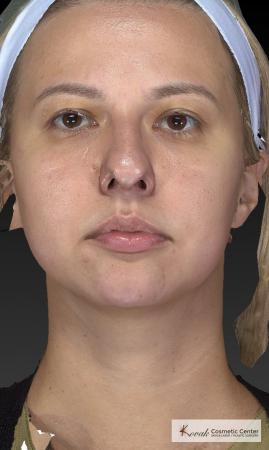 Restylane® Lyft: Patient 1 - After 4