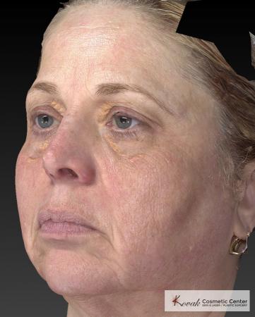 Tyte And Bryte – Face: Patient 3 - After Image 3