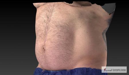 CoolSculpting®: Patient 20 - After 4