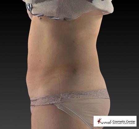 CoolSculpting®: Patient 10 - After 4
