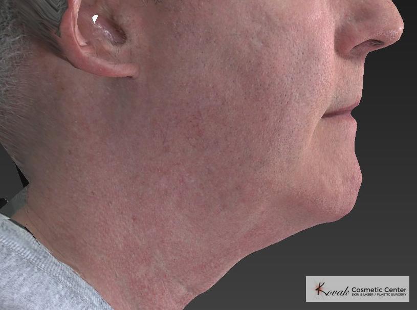 Kybella: Patient 4 - Before 