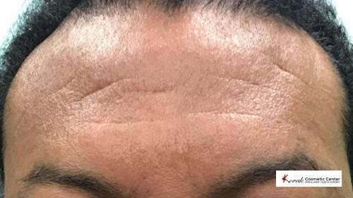 Restylane® Silk: Patient 7 - Before 