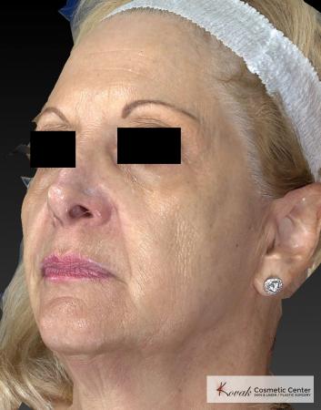 Sculptra®: Patient 5 - Before 3