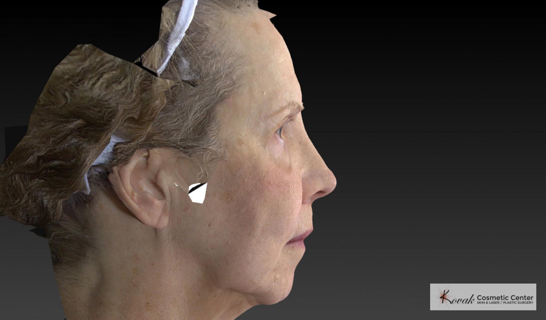 Sculptra®: Patient 3 - After  