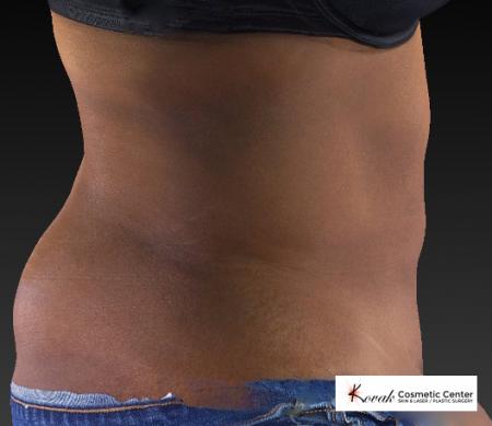 CoolSculpting®: Patient 15 - After 3