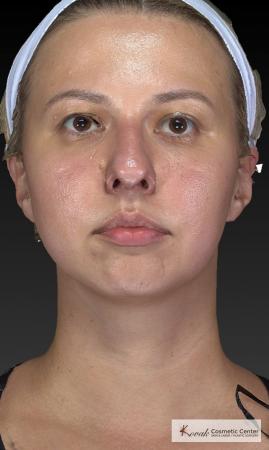 Restylane® Lyft: Patient 1 - Before 4