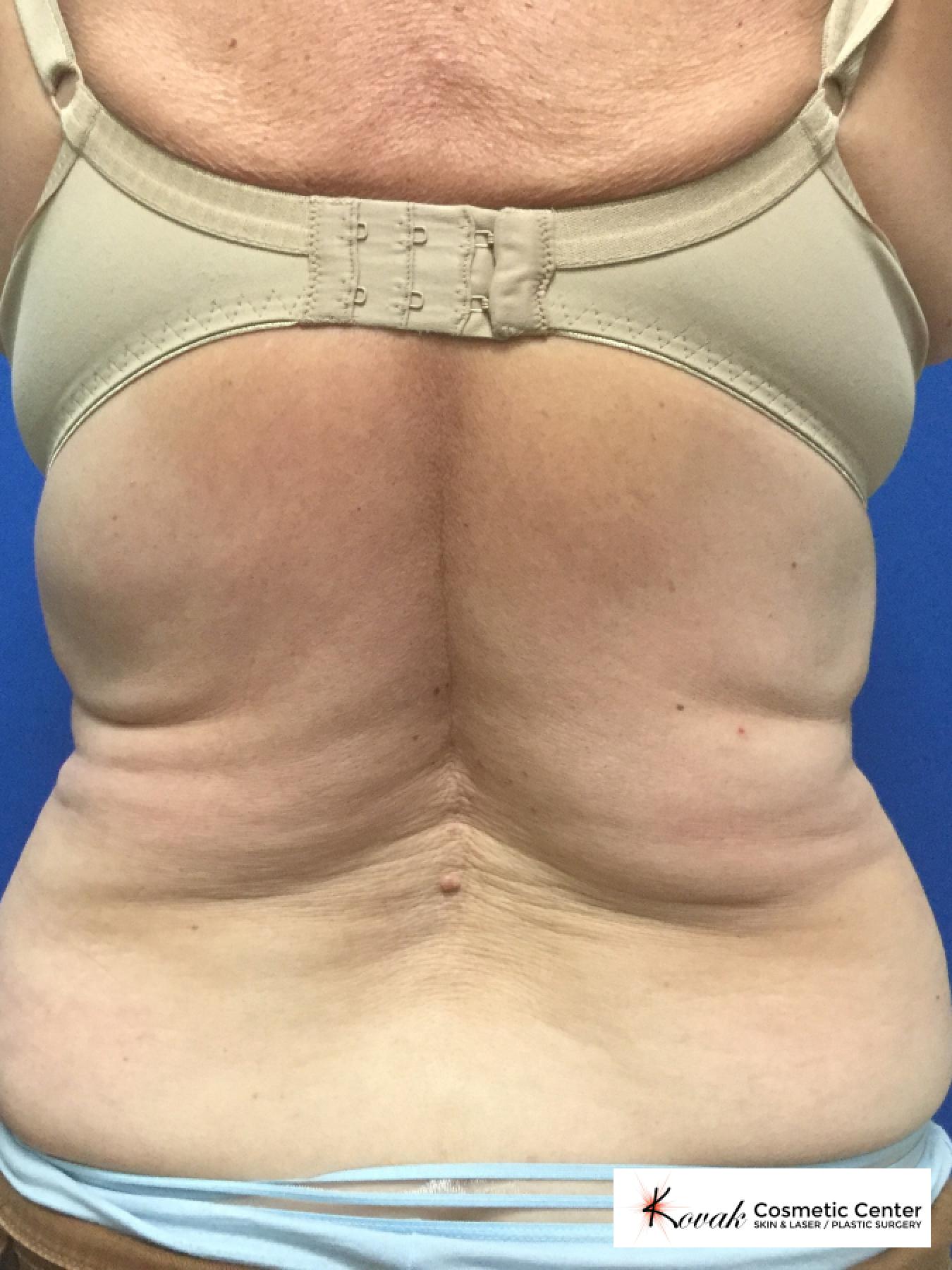CoolSculpting®: Patient 3 - After  