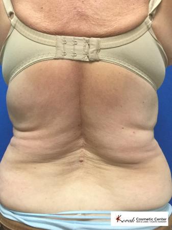 CoolSculpting®: Patient 3 - After 1