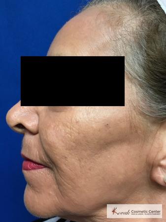 Full Face Laser Skin Resurfacing on a 70 year old woman - After Image 2