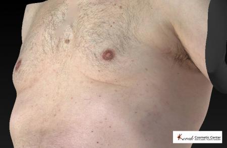 CoolSculpting®: Patient 7 - After 2
