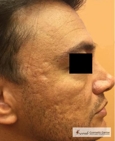 Juvéderm® XC: Patient 9 - Before and After 2