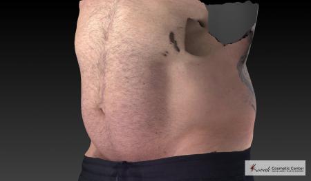 CoolSculpting®: Patient 20 - Before 4