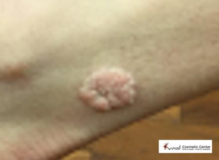 Wart(s): Patient 3 - Before Image 1