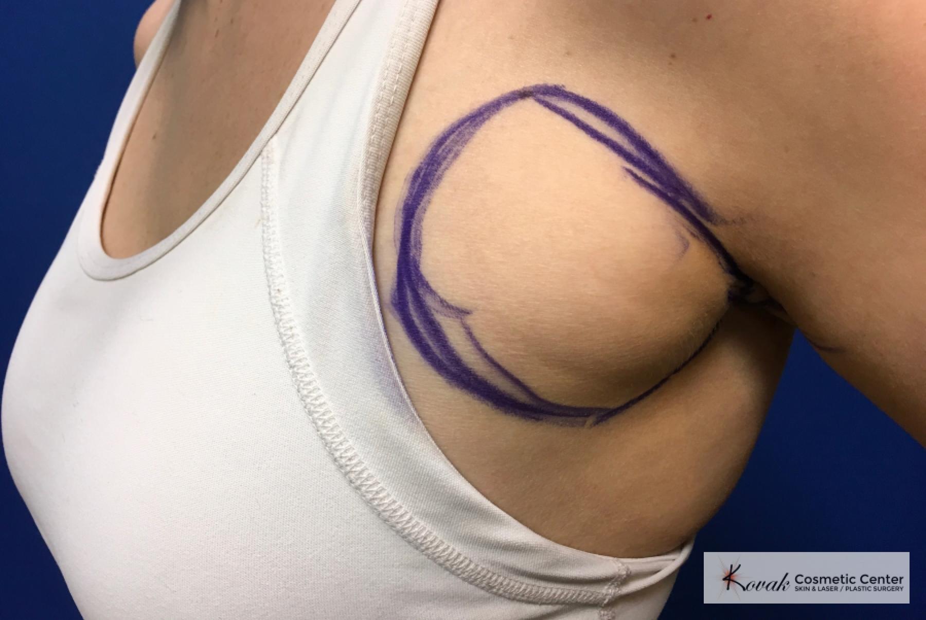 Laser Liposuction: Patient 4 - Before 