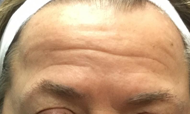 Case 222 - Before 
