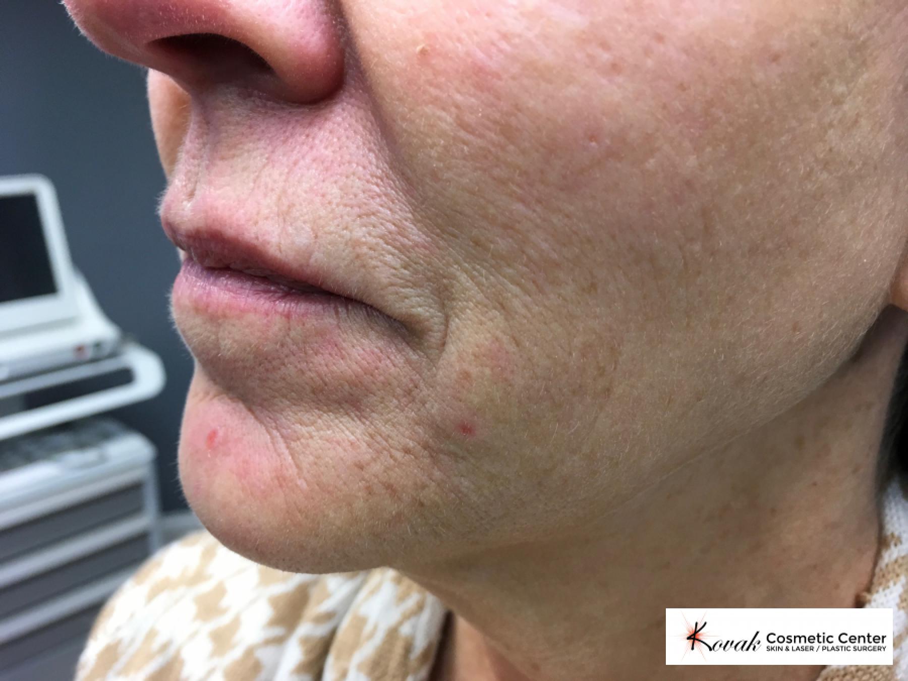 Restylane® Silk: Patient 4 - Before and After 2