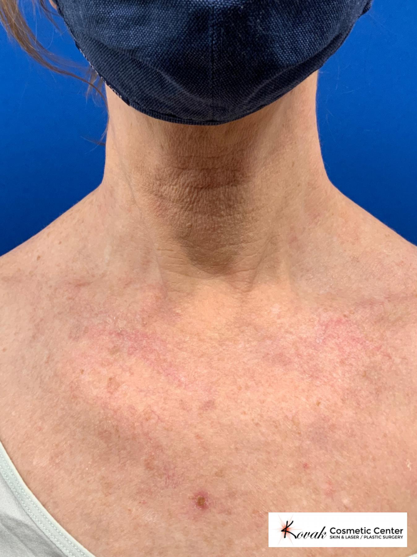 Microneedling on the neck of a 61 year old female using Scarlet - After  