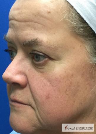 Restylane® Silk: Patient 13 - Before 2