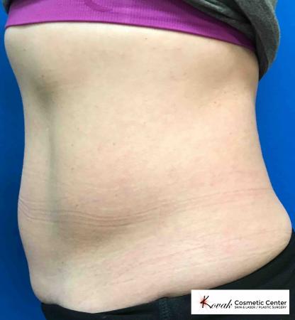 CoolSculpting®: Patient 2 - Before and After 2