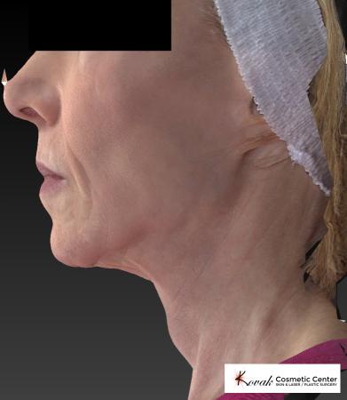 Sculptra®: Patient 1 - After 5