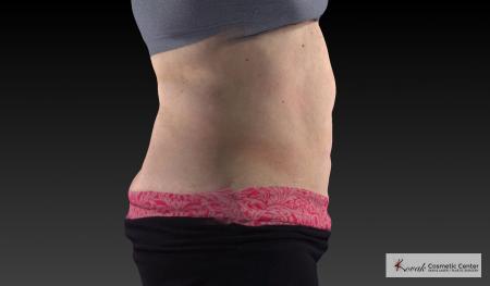 CoolSculpting®: Patient 18 - Before 4